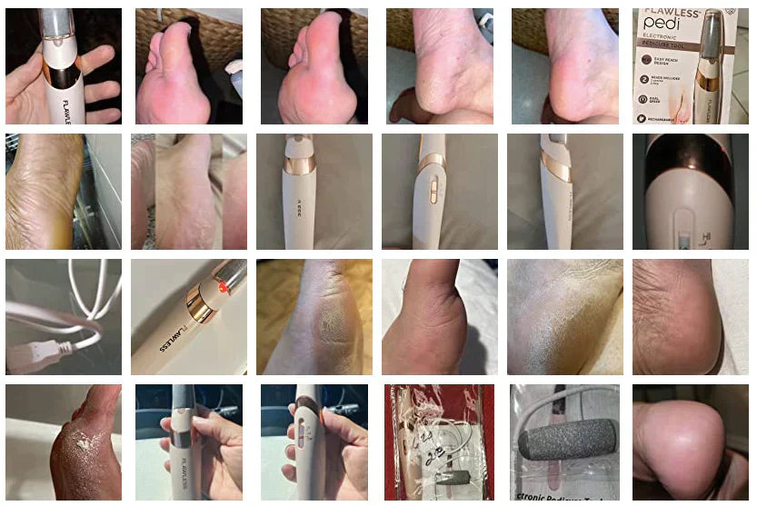Rough Skin Remedy™ | Electric foot Callus Remover